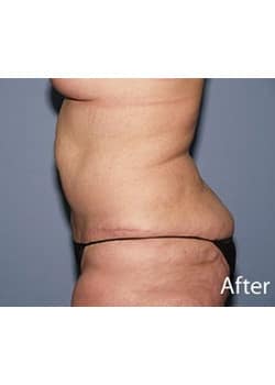 After Image: Body Lift - other