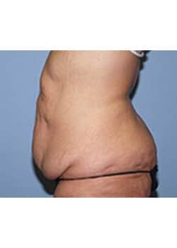 Before Image: Body Lift - other