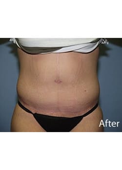 After Image: Body Lift - front