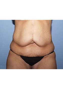 Before Image: Body Lift - front