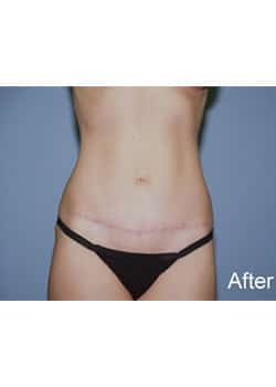 After Image: Mini Abdominoplasty
