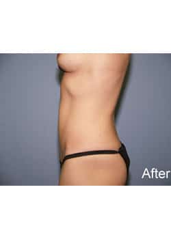 After Image: Mini Abdominoplasty - other