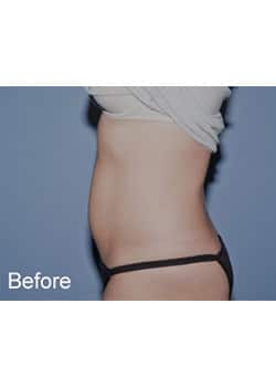 Before Image: Mini Abdominoplasty - other