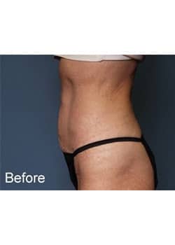 Mini Abdominoplasty