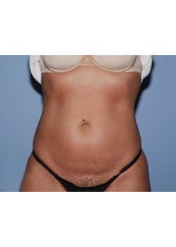 Mini Abdominoplasty
