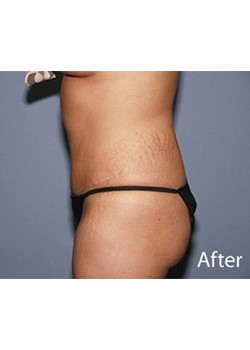 Liteshape Laser Liposuction