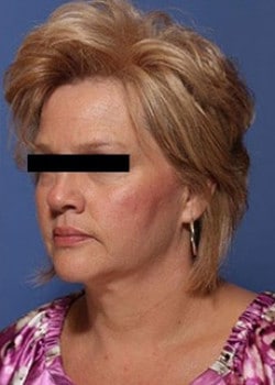 Liteshape Laser Liposuction