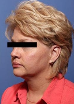 Liteshape Laser Liposuction
