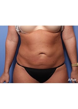 After Image: Liteshape Laser Liposuction