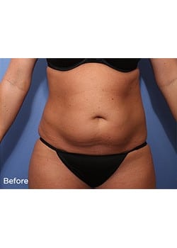 Before Image: Liteshape Laser Liposuction