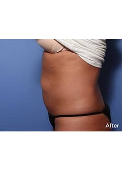After Image: Liteshape Laser Liposuction - other