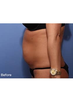 Before Image: Liteshape Laser Liposuction - other