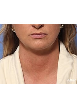 After Image: Liteshape Laser Liposuction