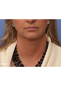 Before Image: Liteshape Laser Liposuction