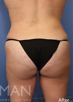 After Image: Brazilian Butt Lift - back