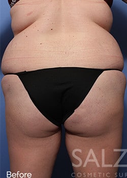 Before Image: Brazilian Butt Lift - back