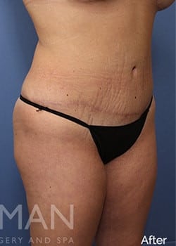 After Image: Brazilian Butt Lift - right-front-oblique