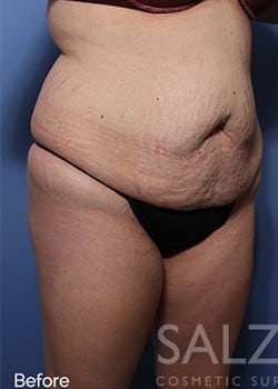 Before Image: Brazilian Butt Lift - right-front-oblique