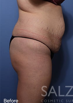 Before Image: Brazilian Butt Lift - other
