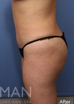After Image: Brazilian Butt Lift - other