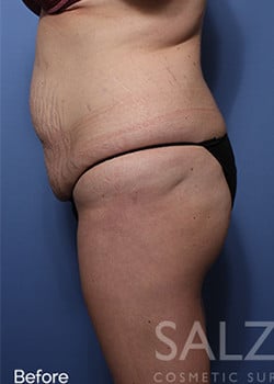 Before Image: Brazilian Butt Lift - other