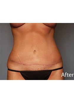 Tummy Tuck