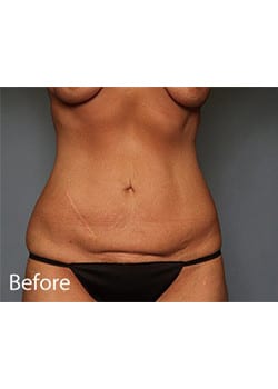 Tummy Tuck