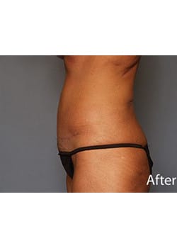 Tummy Tuck