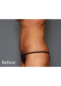 Tummy Tuck