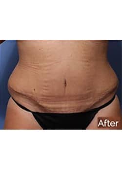 Tummy Tuck