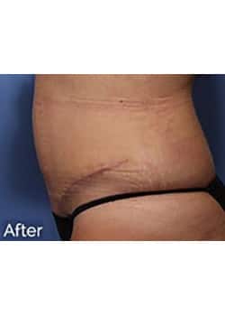 Tummy Tuck