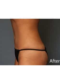After Image: Tummy Tuck - other