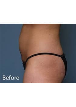 Before Image: Tummy Tuck - other