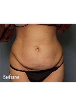 Tummy Tuck