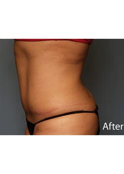Tummy Tuck