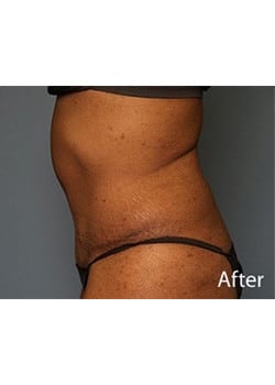 Tummy Tuck