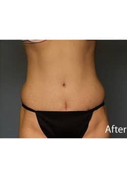 After Image: Tummy Tuck - front