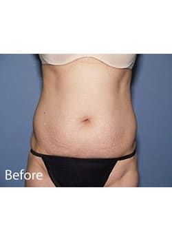Before Image: Tummy Tuck - front
