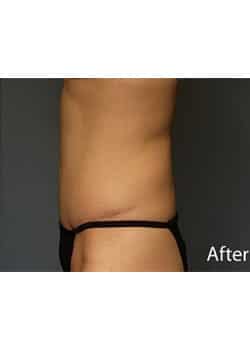 After Image: Tummy Tuck - other