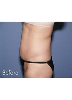 Before Image: Tummy Tuck - other