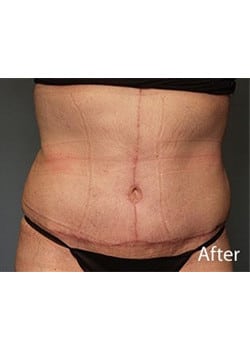 Tummy Tuck