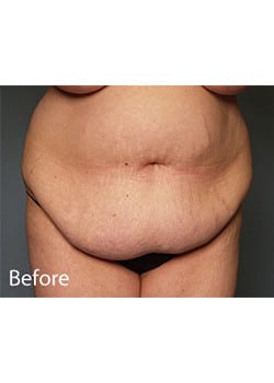 Tummy Tuck