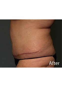 Tummy Tuck
