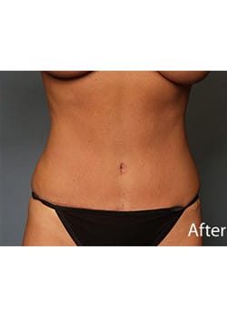 After Image: Tummy Tuck - front