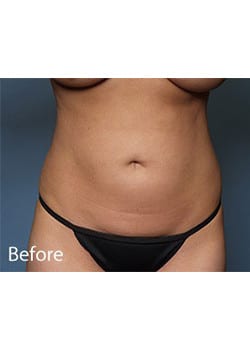 Before Image: Tummy Tuck - front