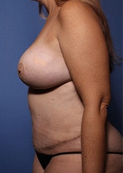 Tummy Tuck