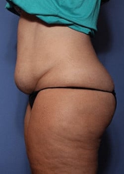 Tummy Tuck
