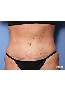 After Image: Tummy Tuck - front