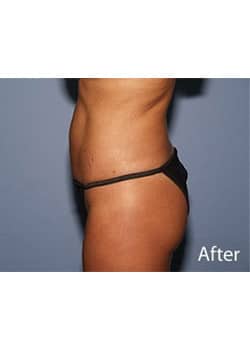 Liposuction