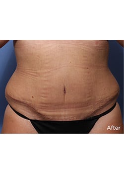 Tummy Tuck